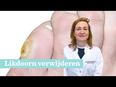 Likdoorn (eksteroog) verwijderen: Hoe doe je dat?