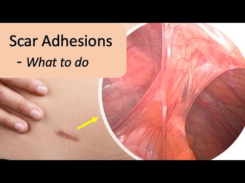 Scar Adhesion Symptoms, Pain, Prevention and Treatment.
