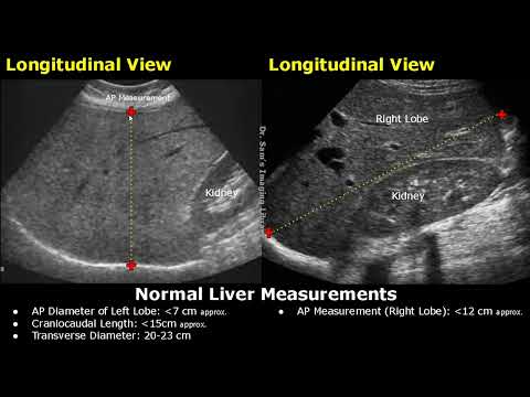 How To Measure Liver On Ultrasound | Craniocaudal Length, Transverse, Volume & AP Measurements USG